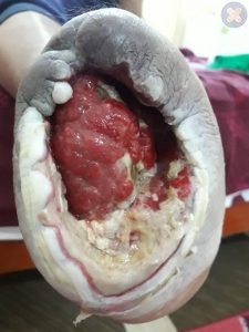 امپوتاسیون از ناحیه مچ پا در یک بیمار دیابتی