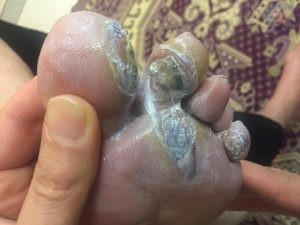 سوختی انگشتان پا در یک بیمار دیابتی