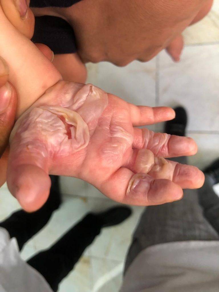 تاول سوختگی کودک