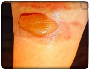 تاول سوختگی در اثر ریختن قهوه داغ بر روی پا