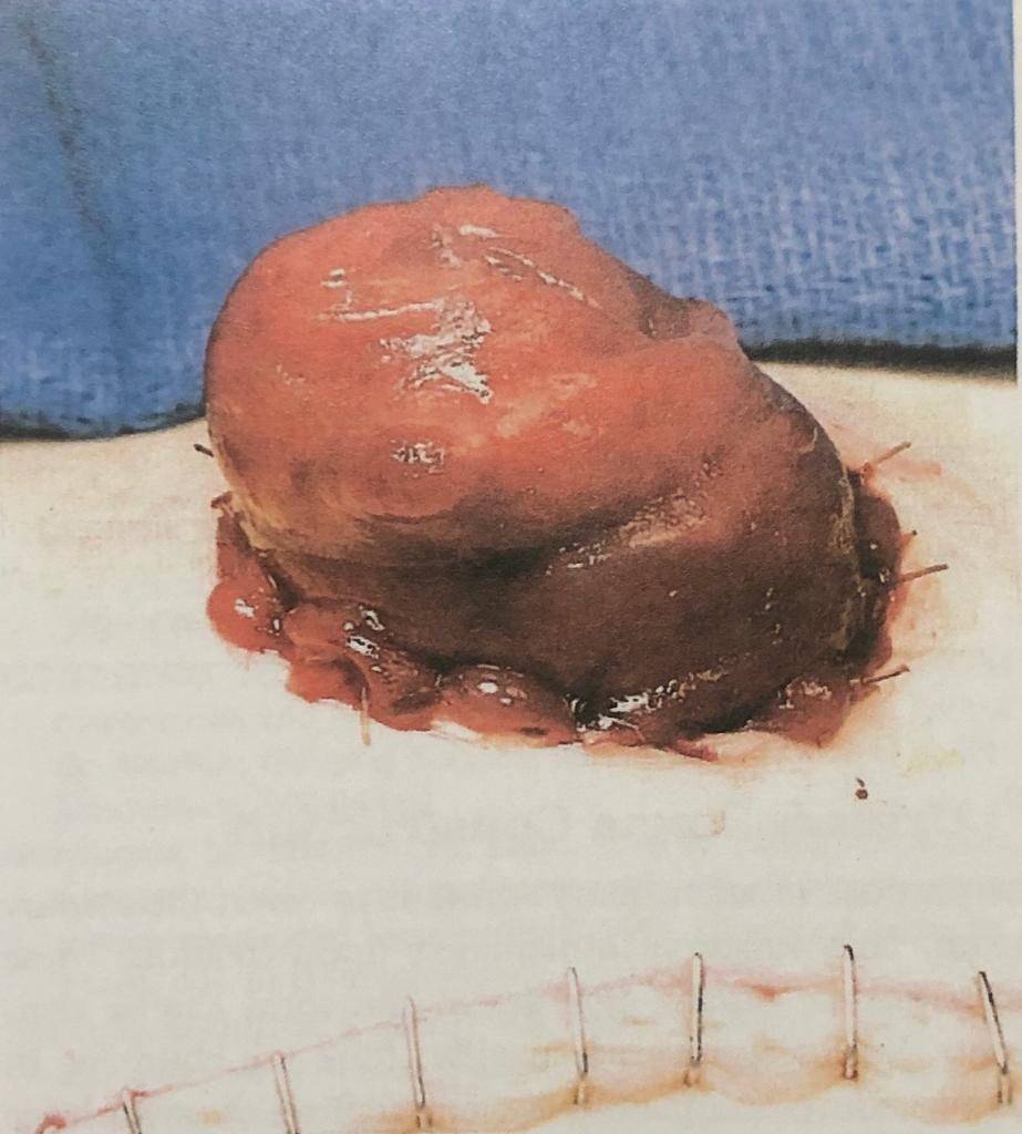 ostoma