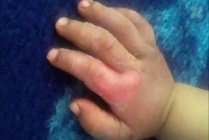 سوختگی با آب حوش در کودک دو ساله پس از برداشتن تاول