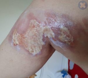 زخم سوختگی عمیق با مایع داغ در ناحیه زانوی داخلی پا