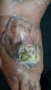 عفونت روی پا در محل انجام پیوند پوست