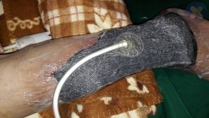 وکیوم درمانی ساق پا