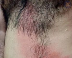 سوختگي درجه يك افتاب