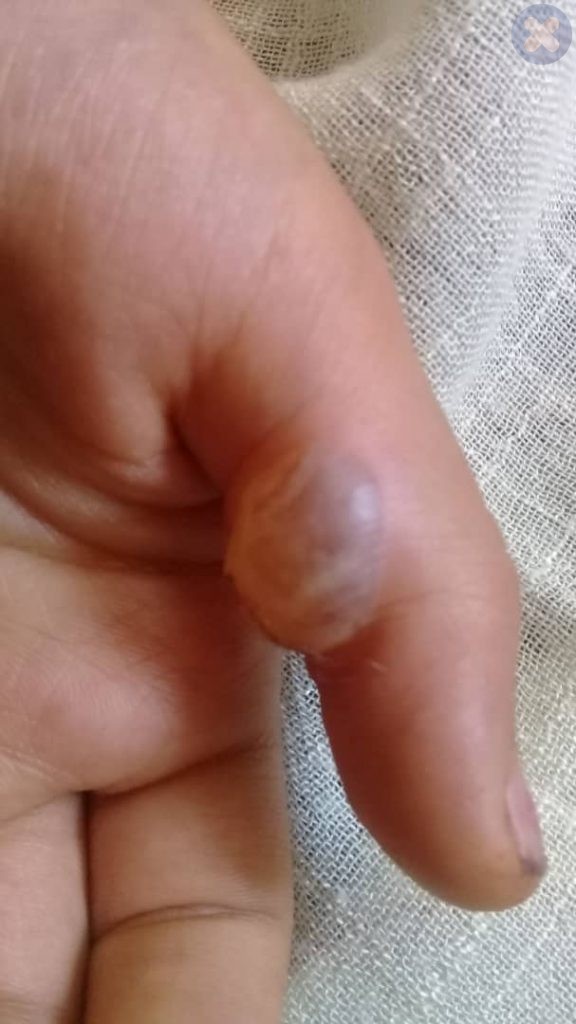سوختگی با چسب حرارتی