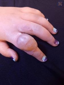 سوختگی در اثر گاز مایع روی انگشت