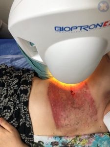 استفاده لز دستگاه بایوپترون سوییسی برای درمان زخم ناشی از پرتو درمانی