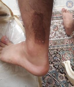 سوختگی با یخ