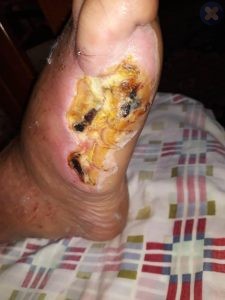 امپوتاسیون انگشت کوچک پا به دلیل مشکل عروقی.اگر مشکل خونرسانی رفع نشود اندام در معرض امپوتاسیون قرار می‌گیرد.