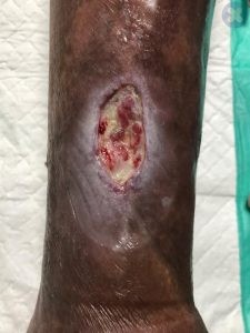 زخم عروقی روی ساق پا...به ظاهر خشک زخم و لبه های منظم زخم توجه داشته باشید