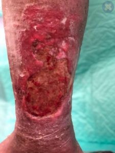 قرمزی و التهاب در حاشیه زخم وریدی