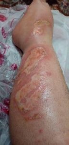 سوختن پای یک فرد مبتلا به دیابت با بخاری در اثر بی حسی