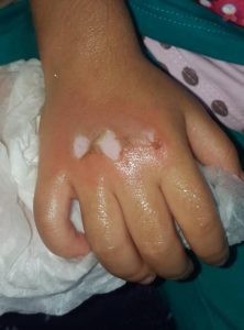سوختگی با بخاری در ناحیه دست