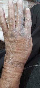سوختگی با بخاری در ناحیه دست در اثر نوروپاتی