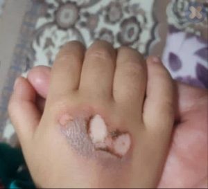 سوختگی با بخاری در کودک چهار ساله