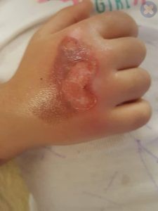 سوختگی با شیشه بخاری در کودک چهار ساله