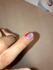 زخم له شدگی انگشت