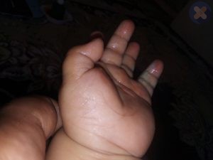 چسبیدن نوک انگشتان کودک پر اثر برخورد با بخاری