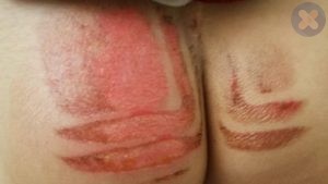 چسبیده شدن باسن کودک در حین برخورد با بخاری