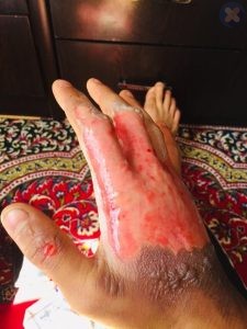 به سوختن سطح وسیعی از پوست دست بر اثر جرقه آرک دقت کنید