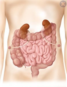 جراحی از طریق میزنای Ureterostomy