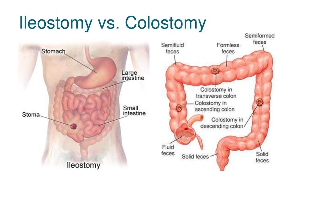 ایلئوستومی در برابر کلستومی