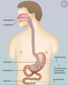 jejunostomy