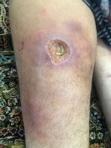 سلولیت و عفونت پا